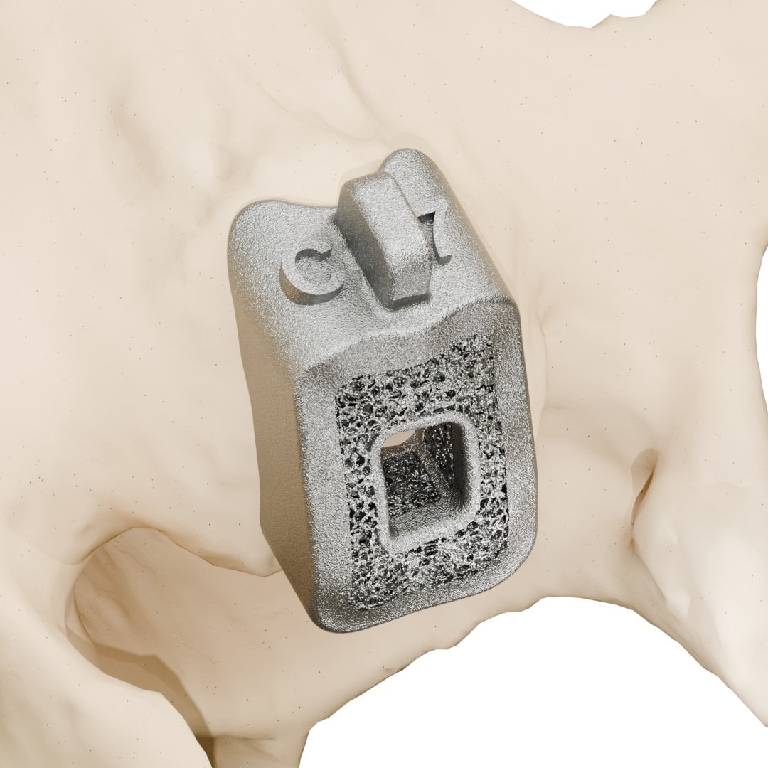 Spacer With Single Bone